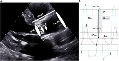 Invasive assessment of aortic stenosis in contemporary practice